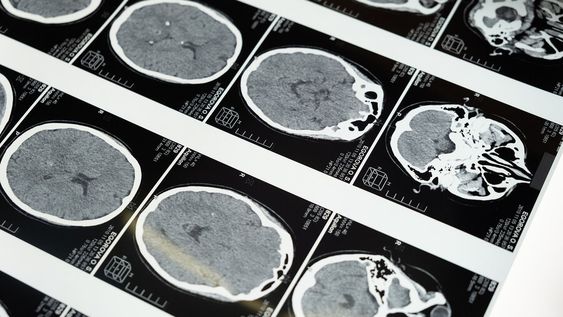 Se extiende en varios países el uso de productos tecnológicos que analizan la actividad cerebral. Foto: Pexels Se extiende en varios países el uso de productos tecnológicos que analizan la actividad cerebral. Foto: Pexels