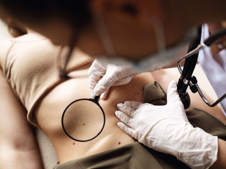 Pautas para prevenir el cáncer de piel e identificar los primeros indicios