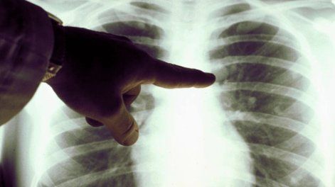 Radiografías torácicas, imagen a modo de ilustración