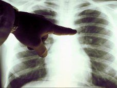 Radiografías torácicas, imagen a modo de ilustración Radiografías torácicas, imagen a modo de ilustración