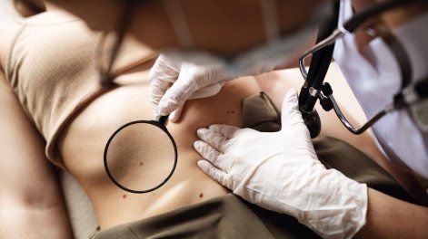 Pautas para prevenir el cáncer de piel e identificar los primeros indicios